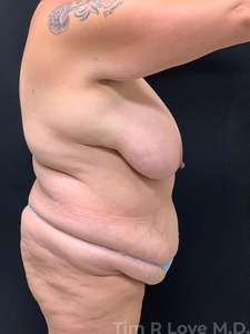 Abdominoplasty - Traditional-before
