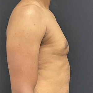 Male Breast Reduction #8-after