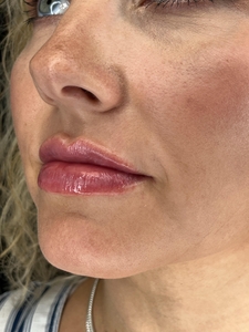 1 syringe Restylane Kysse in lips-after