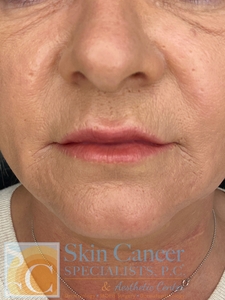 Patient had filler to lips and around mouth.-after