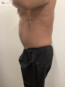 After 1 Instasculpt treatment-before