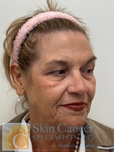 Sculptra and filler around mouth-after