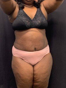 Lipo 360 + mini tummy tuck-after