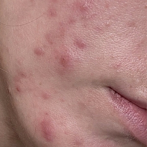 Laser Resurfacing #3-before