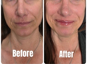 MB - Filler: Nasolabial Folds-before