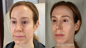 Filler RB B/A Left Oblique-before