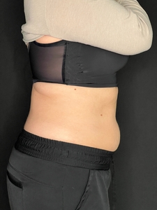 Ashley Reich RN. - Lower Abdomen-after