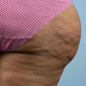 Cellulite Reduction #2-before