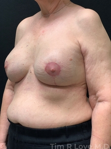 Implant Exchange-after