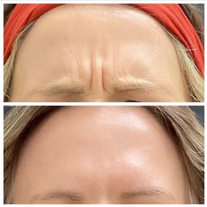 Botox-before