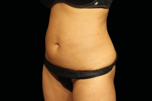 2 Weeks after last treatment-after