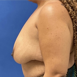 Breast Lift #6-before