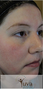 4 vitalize peels-after