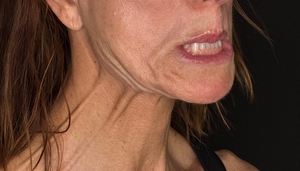 Ashley Reich RN: Platysmal Bands-before