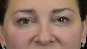 Undereye/Midface filler-after