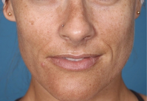 Hyperpigmentation-before