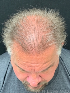 2000 grafts-after