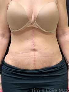 Vertical abdomen revision 5'3