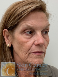 Sculptra and filler around mouth-before