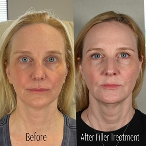 Filler B/A ST-before