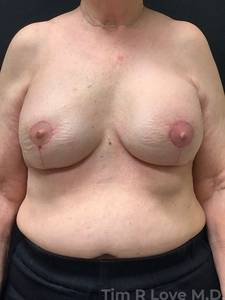 5'2 180lb. Bilateral mastopexy and implant exchange from 400cc to 385cc moderate profile-after