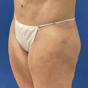 Lipo w Renuvion #1-after