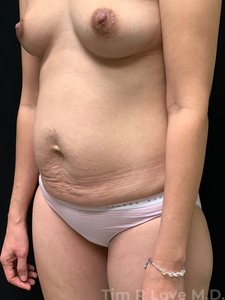 Abdominoplasty - Traditional-before