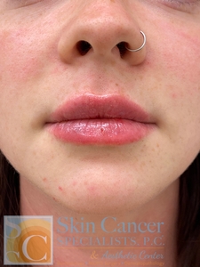 lip filler-after