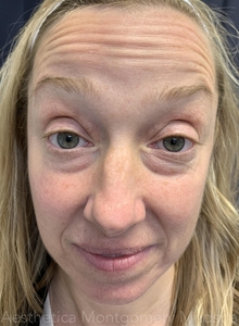 forehead Before and after jeuveau-before