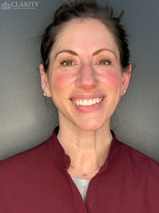 crow's feet (front)-before