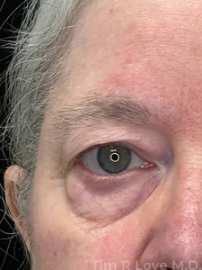 with lower lid Morpheus/Fractora-before