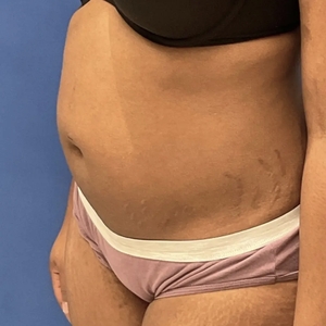 Lipo w Renuvion #10-before