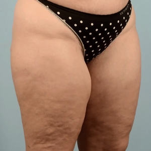 Lipo w BodyTite #7-before