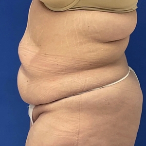 Tummy Tuck #14-before