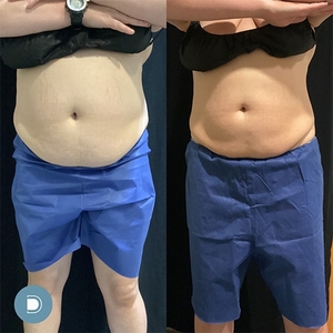 Coolsculpting-before