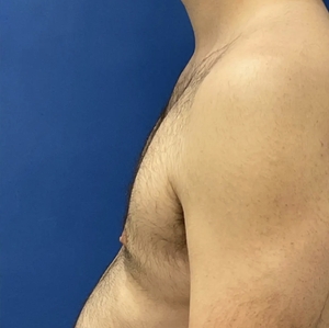 Male Breast Reduction #5-after