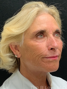 1 year post op face and neck lift, Morpheus8, Fraxel, Nanofat, Sculptra, Lip filler-after