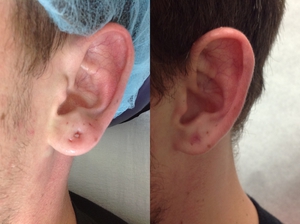 Gauged Earlobe Repair-before