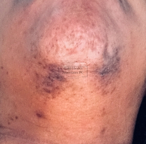 Hyperpigmentation of Chin-before