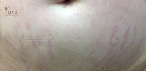 4 tretments for strech mark at Yuva-before
