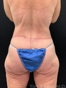 Circumferential Lift-after