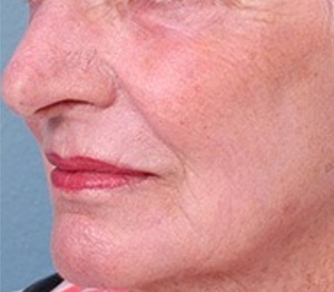 Laser Resurfacing #2-after