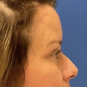 Brow & Eye Lift #2-after