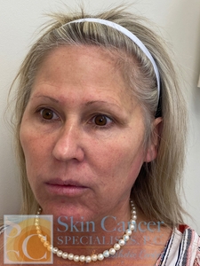 Lower Face Nova Threads-before