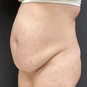 Tummy Tuck #11-before