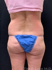 525cc of fat grafting-before