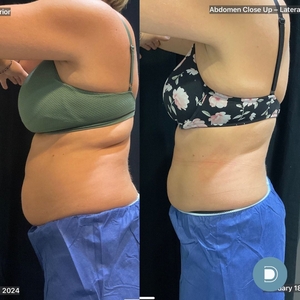 Coolsculpting-before