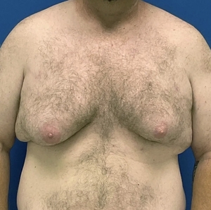 Male Breast Reduction #3-before