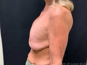 Implant Exchange-before