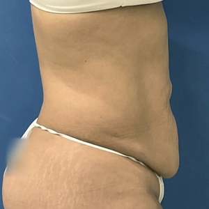 Tummy Tuck #2-before